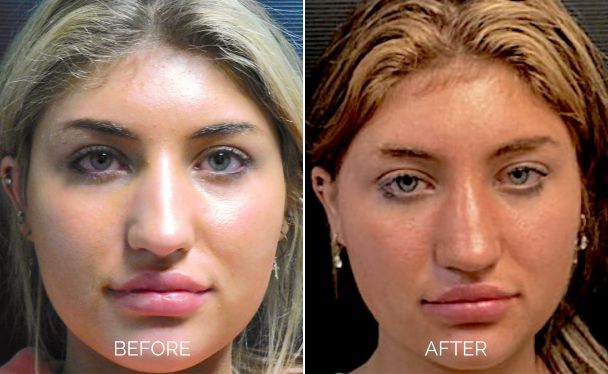 Rhinoplasty before and after front showing an enhanced nose appearance.