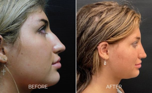 Rhinoplasty before and after right sideview showing an enhanced nose appearance.