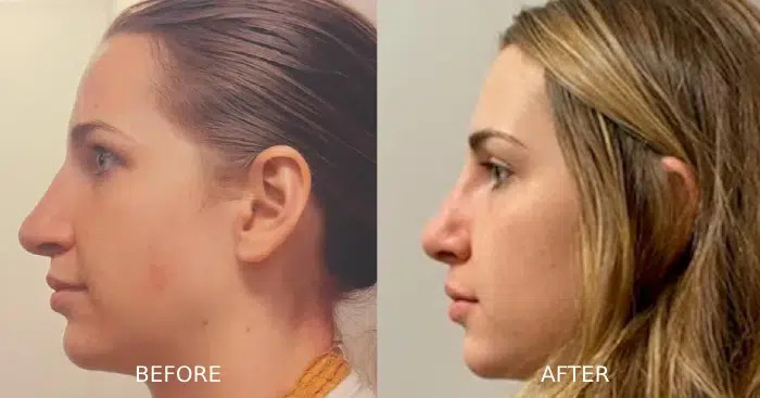 Rhinoplasty before and after left sideview showing an enhanced nose appearance.