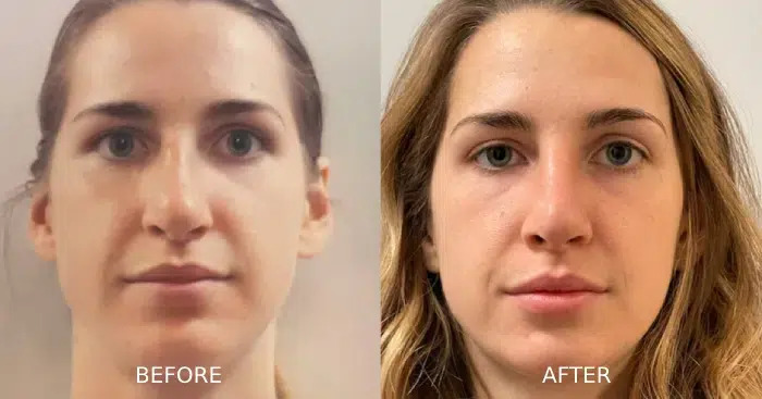 Rhinoplasty before and after front showing an enhanced nose appearance.