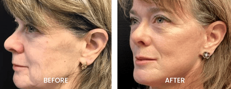 Facelift-Before-and-After Boulder Valley Laser & Cosmetic Boulder, CO L40 (1)